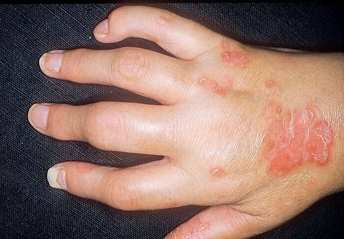łuszczycowe zapalenie stawów rąk