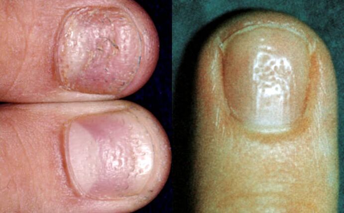 Objaw naparstka - liczne wgłębienia na powierzchni płytki paznokcia