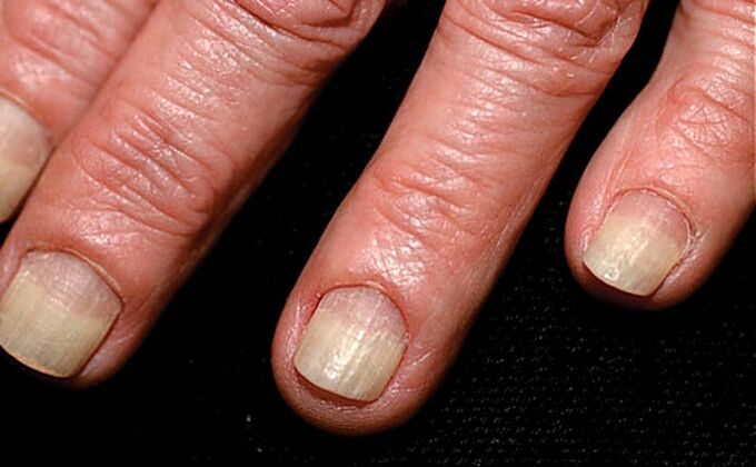 Rozprzestrzenianie się onycholizy od krawędzi paznokcia do fałdu paznokcia