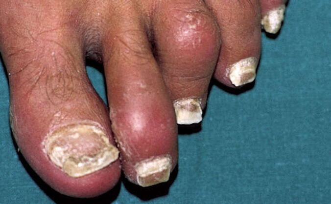 Łuszczyca z zajęciem paznokci i zapaleniem stawów (artretyzm) palców stóp