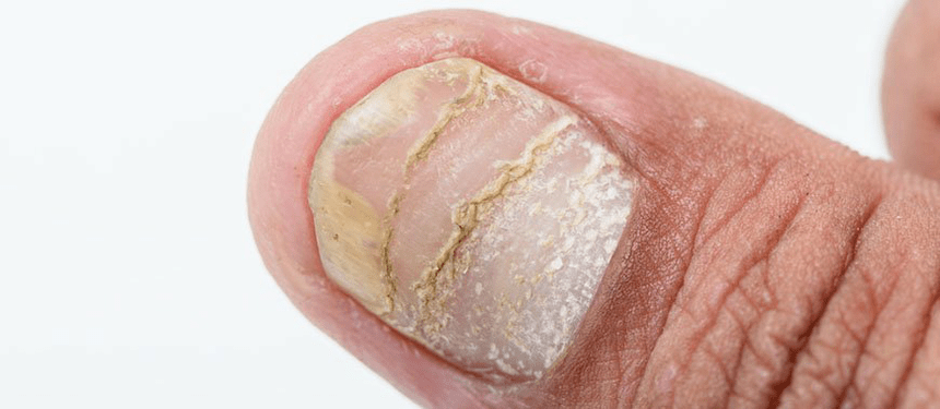 ostra postać powikłań łuszczycy na paznokciach